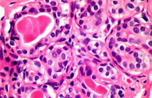 Βρετανοί φαίνεται πως ανακάλυψαν ανοσοποιητικό κυττάρο που «σκοτώνει» τον καρκίνο