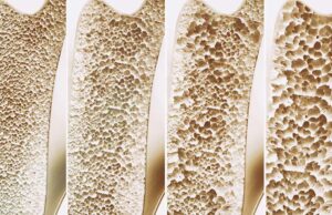 Οστεοπόρωση: Αίτια, διάγνωση και θεραπεία. Του δρα Φώτη Κοσματόπουλου