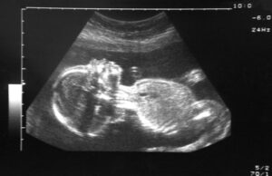 Τα σωματίδια της ατμοσφαιρικής ρύπανσης φτάνουν μέχρι τον πλακούντα του εμβρύου