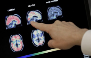 Σπουδαία ανακάλυψη για το Αλτσχάιμερ: Βρέθηκε εξέταση αίματος για τη διάγνωση της νόσου