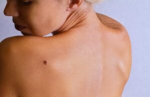 Το πρώτο διαγνωστικό εμφύτευμα που προδίδει τον πρώιμο καρκίνο