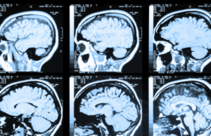 Μαγνητική τομογραφία τεχνητής νοημοσύνης εντοπίζει νωρίς τη νόσο Αλτσχάιμερ