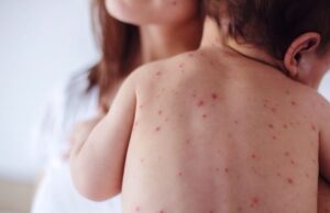 Συναγερμός για την ιλαρά στην Ευρώπη το 2018