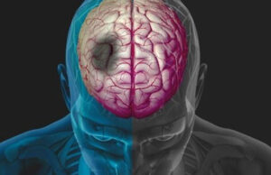 ΤΕΠΑΚ Έρευνα: Βελτίωση των συμπτωμάτων του λόγου μετά από ένα εγκεφαλικό επεισόδιο