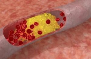 Παγκόσμια Ημέρα Ευαισθητοποίησης για την Οικογενή Υπερχοληστερολαιμία και Κυπριακό Μητρώο Καταγραφής Ασθενών (Cy-FH)