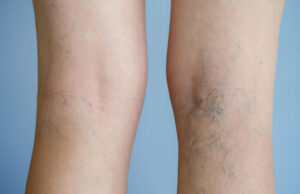 Οι ψηλοί άνθρωποι κινδυνεύουν περισσότερο να εμφανίσουν κιρσούς