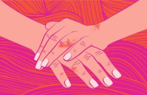 Ενημερωτική εκστρατεία «More Than My Skin» για τη ψωριασική νόσο, στα πλαίσια της Παγκόσμιας Ημέρας Ψωρίασης