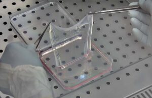 Μεταμόσχευσαν νέα επιδερμίδα σε επτάχρονο