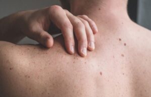 Σχεδόν ένας στους δέκα Ευρωπαίους έχει καρκίνο του δέρματος