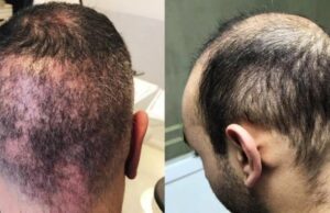 Οι δερματολόγοι προειδοποιούν για μεταμοσχεύσεις μαλλιών χαμηλού κόστους