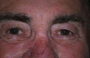 Τεστ δακρύων για τη διάγνωση της νόσου Πάρκινσον