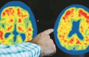 Δύο φάρμακα δίνουν ελπίδα σε ασθενείς με Αλτσχάιμερ