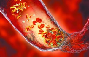 Η ήπια COVID-19 γερνά τις αρτηρίες πιο γρήγορα