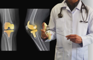 Επιστήμονες ανέπτυξαν ένα 3D-printed τεχνητό γόνατο