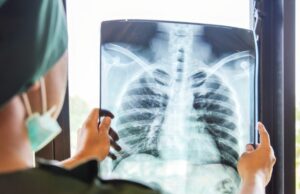 Στην τελική φάση των κλινικών δοκιμών το εμβόλιο κατά της φυματίωσης