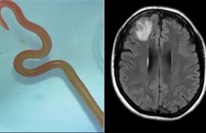 Σκουλήκι 8 εκατοστών αφαιρέθηκε από τον εγκέφαλο γυναίκας