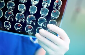 «Θερίζει» ο καρκίνος σε ηλικίες κάτω των 50 – Αύξηση κατά 79% σε 30 χρόνια