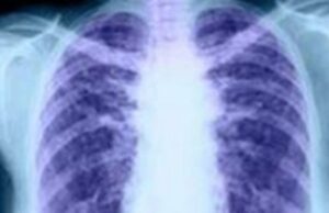 Τα άτομα με παθήσεις των πνευμόνων αντιμετωπίζουν επιπλέον κινδύνους από την κλιματική αλλαγή