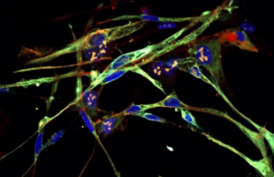 Ερευνητές μετέτρεψαν καρκινικά κύτταρα σε μυϊκά