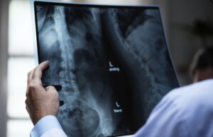 Η ΑΙ εντόπισε… αναπάντεχο φάρμακο για την οστεοπόρωση