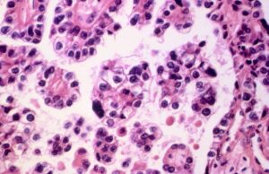 Καρκίνος του τραχήλου της μήτρας: Νέα θεραπεία είναι «η σημαντικότερη εξέλιξη της 20ετίας»