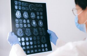 Έρευνα αποκαλύπτει πως το κοιλιακό λίπος συνδέεται με τη νόσο Αλτσχάιμερ