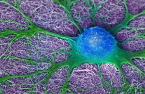 Ενέσεις ελπίδας – Βλαστοκύτταρα δοκιμάστηκαν για πρώτη φορά στη σκλήρυνση κατά πλάκας