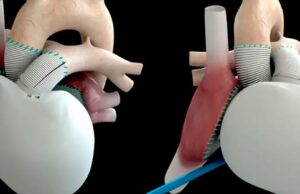 Το όνειρο της τεχνητής καρδιάς