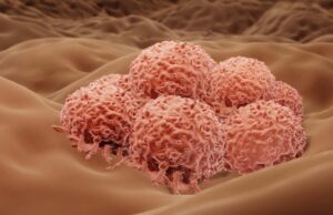 Έτοιμο για έγκριση το εμβόλιο που καταπολεμά το μελάνωμα (μορφή καρκίνου του δέρματος)