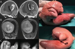 Τα 10 παράξενα ιατρικά περιστατικά του 2023 – Από «γούνινη» γλώσσα μέχρι… έμβρυο στον εγκεφάλο μωρού