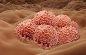 50% μείωση της πιθανότητας θανάτου από καρκίνο του δέρματος με νέα ισχυρή θεραπεία