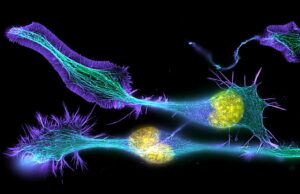 Σκλήρυνση κατά πλάκας: Αρχαίο DNA αποκαλύπτει το λόγο για τα υψηλά ποσοστά στην Ευρώπη