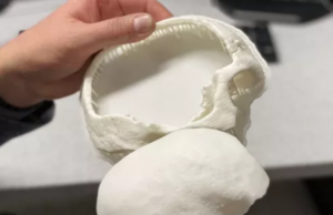 Αυστρία: Δεκάχρονος με κρανιακό εμφύτευμα από 3D εκτυπωτή (Βίντεο)