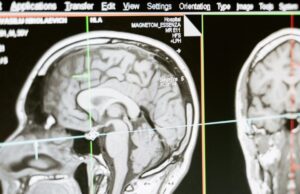 Άνοια: Εξέταση αίματος ίσως προβλέπει την ασθένεια 15 χρόνια πριν τα συμπτώματα