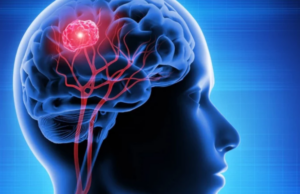 Πειραματική θεραπεία εξαφάνισε όγκο στον εγκέφαλο σε λίγες μέρες