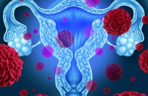 Μυστηριώδη «επιδημία» καρκίνων στην κοιλιά σε νεότερα άτομα βλέπουν οι ειδικοί