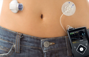 Χιλιάδες διαβητικοί θα λάβουν τεχνητό πάγκρεας στην Αγγλία