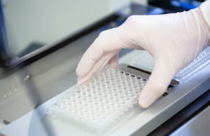 Μοριακό τεστ ούρων ξεχωρίζει τους επικίνδυνους όγκους του προστάτη