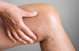 Θρόμβωση στα πόδια: Μια ύπουλη απειλή