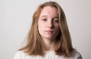 1 στους 5 εφήβους με σοβαρή ακμή αναπτύσσει συμπτώματα κατάθλιψης