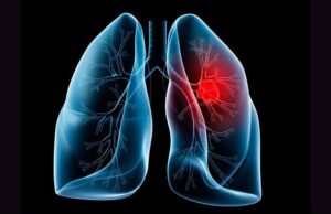 Πετυχημένη (δοκιμαστική) μεταμόσχευση πνεύμονα χοίρου σε άνθρωπο