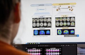 Απλή οικιακή εξέταση εντοπίζει τη νόσο Αλτσχάιμερ χρόνια πριν την εμφάνιση των πρώτων συμπτωμάτων