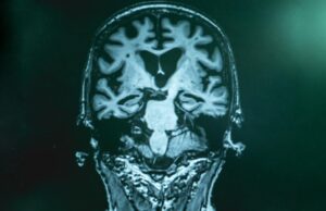 Ένα «κράνος» υπερήχων επιχειρεί να αντιμετωπίσει μη επεμβατικά σοβαρές νευρολογικές παθήσεις