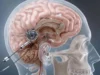 Neuralink: Μαζική παραγωγή εγκεφαλικών εμφυτευμάτων από το 2026 υπόσχεται ο Έλον Μασκ