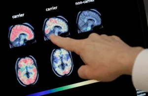 Μελέτη αποκαλύπτει σύνδεση μεταξύ καρκίνου και Αλτσχάιμερ