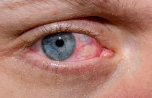 Ο αμφιβληστροειδής αποκαλύπτει πιθανή σύνδεση βακτηρίου με το Αλτσχάιμερ