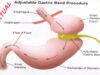 Γαστρικός δακτύλιος: Μια αναστρέψιμη λύση στην παχυσαρκία με όρια, κινδύνους και προϋποθέσεις
