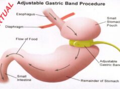 Γαστρικός δακτύλιος: Μια αναστρέψιμη λύση στην παχυσαρκία με όρια, κινδύνους και προϋποθέσεις