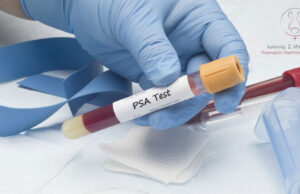 Ο δείκτης PSA και ο καρκίνος του προστάτη: τι πρέπει να γνωρίζουν οι άνδρες